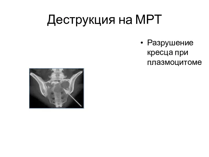 Деструкция на МРТ Разрушение кресца при плазмоцитоме