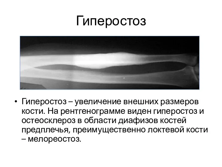 Гиперостоз Гиперостоз – увеличение внешних размеров кости. На рентгенограмме виден гиперостоз