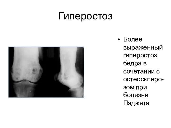 Гиперостоз Более выраженный гиперостоз бедра в сочетании с остеосклеро-зом при болезни Пэджета