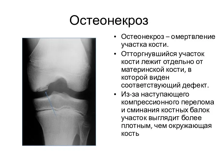 Остеонекроз Остеонекроз – омертвление участка кости. Отторгнувшийся участок кости лежит отдельно