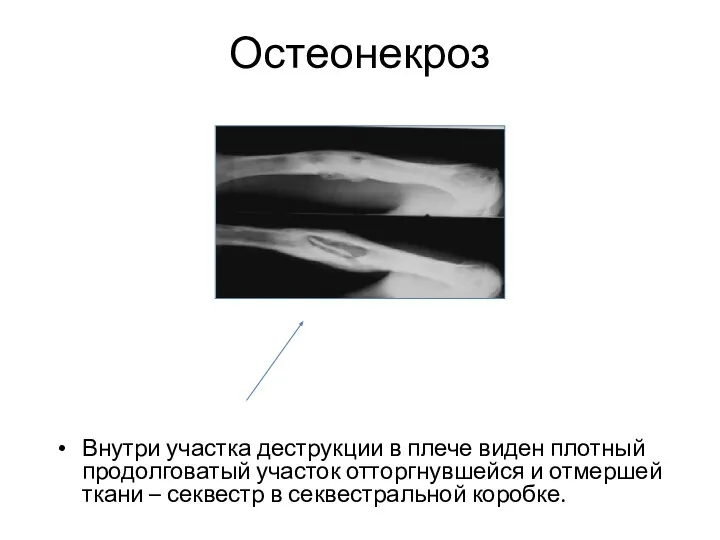Остеонекроз Внутри участка деструкции в плече виден плотный продолговатый участок отторгнувшейся