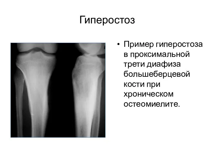 Гиперостоз Пример гиперостоза в проксимальной трети диафиза большеберцевой кости при хроническом остеомиелите.