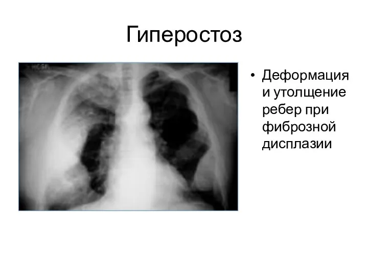 Гиперостоз Деформация и утолщение ребер при фиброзной дисплазии