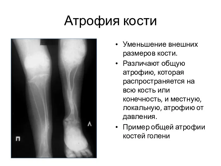 Атрофия кости Уменьшение внешних размеров кости. Различают общую атрофию, которая распространяется