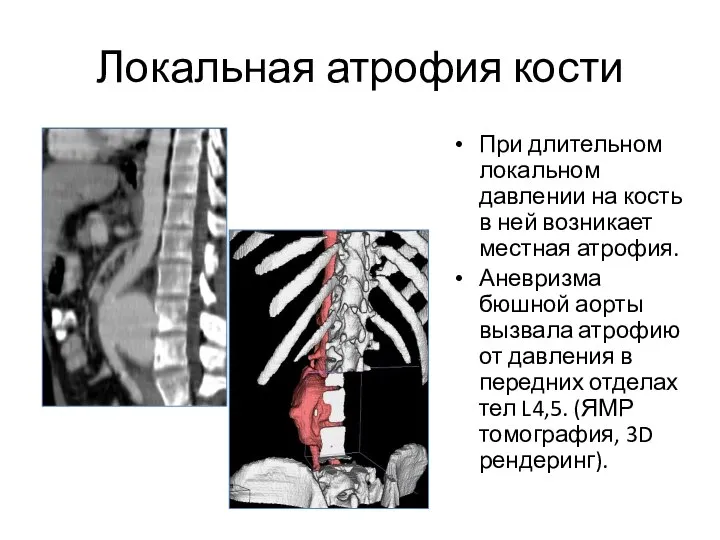 Локальная атрофия кости При длительном локальном давлении на кость в ней