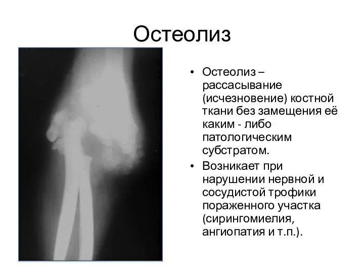 Остеолиз Остеолиз – рассасывание (исчезновение) костной ткани без замещения её каким