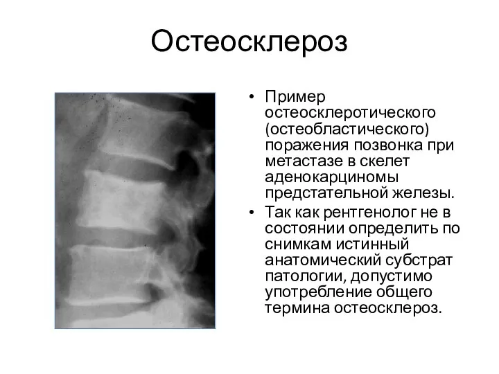 Остеосклероз Пример остеосклеротического (остеобластического) поражения позвонка при метастазе в скелет аденокарциномы