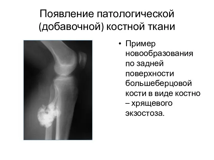 Появление патологической (добавочной) костной ткани Пример новообразования по задней поверхности большеберцовой