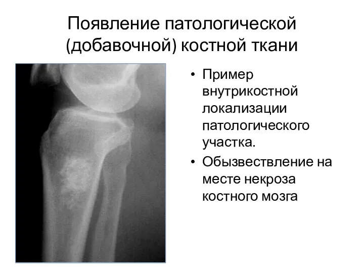 Появление патологической (добавочной) костной ткани Пример внутрикостной локализации патологического участка. Обызвествление на месте некроза костного мозга