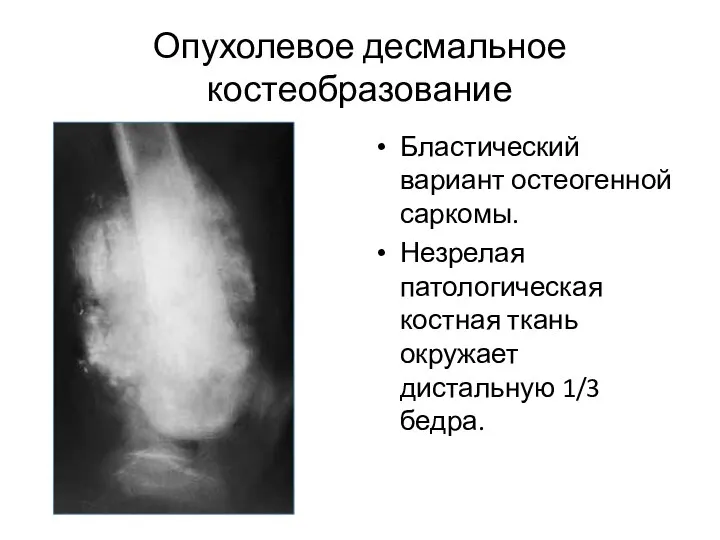 Опухолевое десмальное костеобразование Бластический вариант остеогенной саркомы. Незрелая патологическая костная ткань окружает дистальную 1/3 бедра.