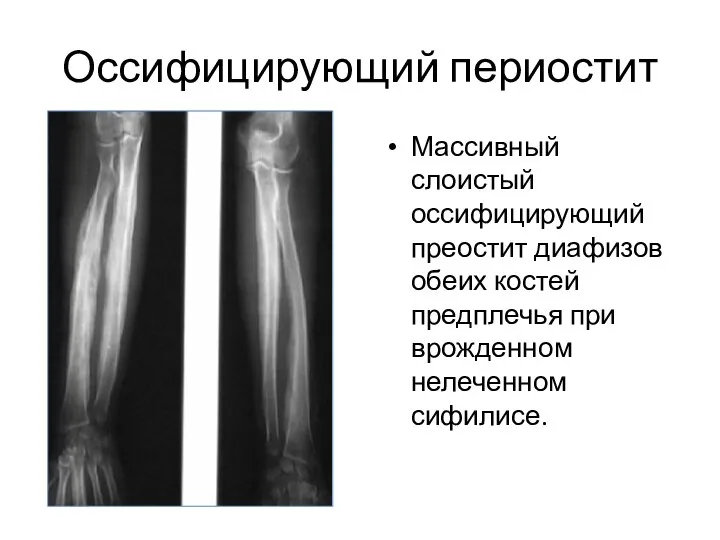 Оссифицирующий периостит Массивный слоистый оссифицирующий преостит диафизов обеих костей предплечья при врожденном нелеченном сифилисе.