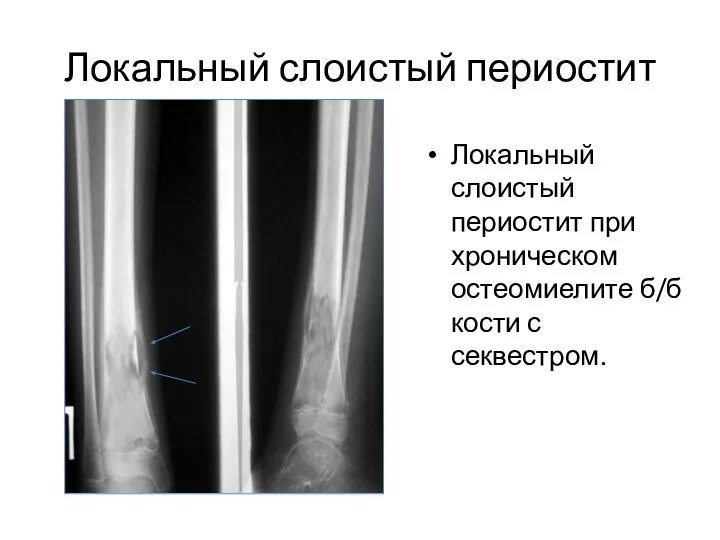 Локальный слоистый периостит Локальный слоистый периостит при хроническом остеомиелите б/б кости с секвестром.