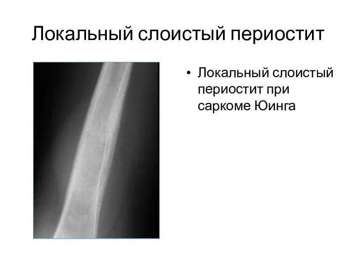 Локальный слоистый периостит Локальный слоистый периостит при саркоме Юинга