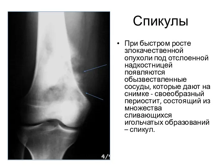Спикулы При быстром росте злокачественной опухоли под отслоенной надкостницей появляются обызвествленные
