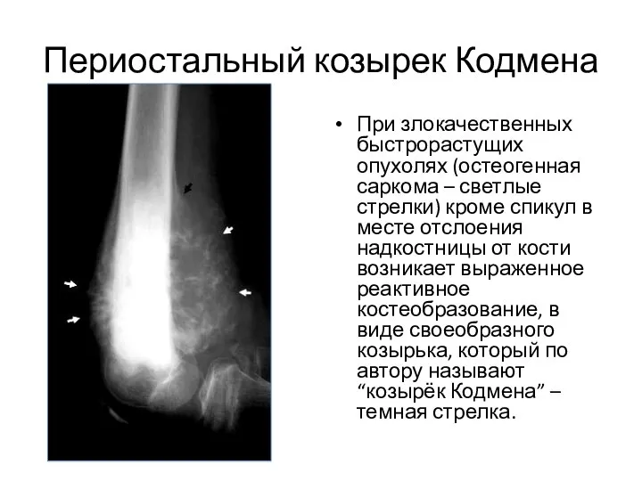 Периостальный козырек Кодмена При злокачественных быстрорастущих опухолях (остеогенная саркома – светлые