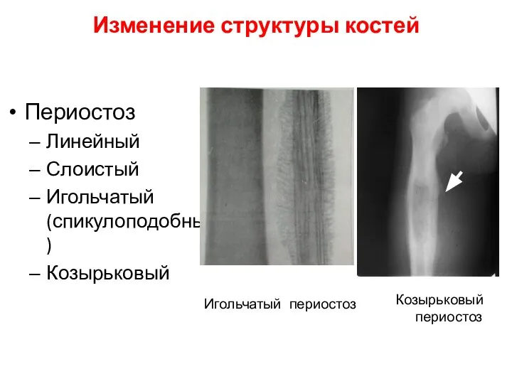 Периостоз Линейный Слоистый Игольчатый (спикулоподобный) Козырьковый Изменение структуры костей Игольчатый периостоз Козырьковый периостоз