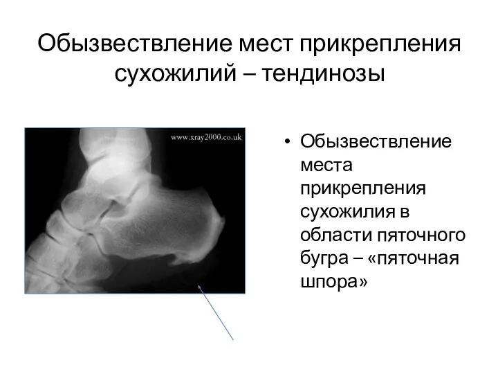 Обызвествление мест прикрепления сухожилий – тендинозы Обызвествление места прикрепления сухожилия в