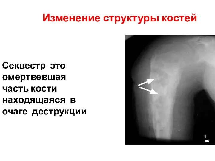 Изменение структуры костей Секвестр это омертвевшая часть кости находящаяся в очаге деструкции