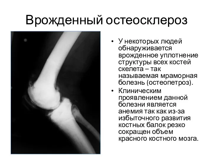 Врожденный остеосклероз У некоторых людей обнаруживается врожденное уплотнение структуры всех костей