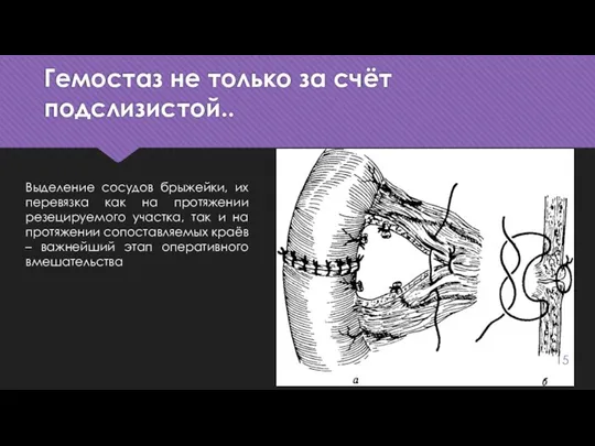 Гемостаз не только за счёт подслизистой.. Выделение сосудов брыжейки, их перевязка