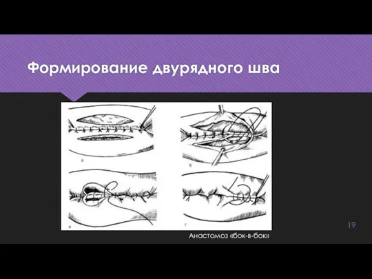 Формирование двурядного шва Анастомоз «бок-в-бок»