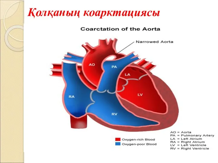 Қолқаның коарктациясы