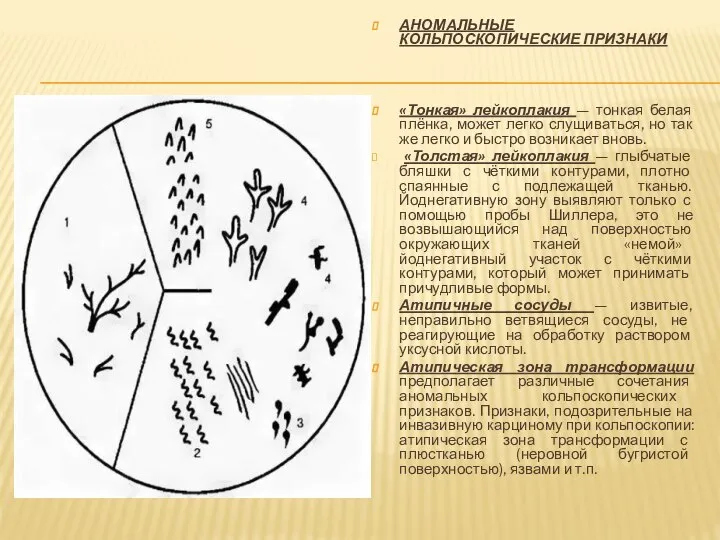 АНОМАЛЬНЫЕ КОЛЬПОСКОПИЧЕСКИЕ ПРИЗНАКИ «Тонкая» лейкоплакия — тонкая белая плёнка, может легко