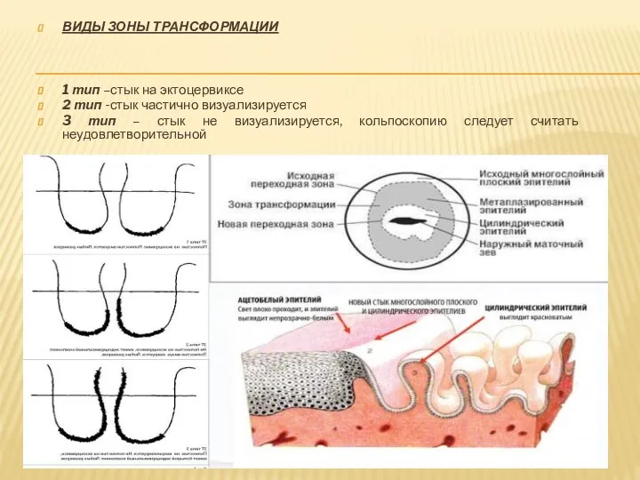 ВИДЫ ЗОНЫ ТРАНСФОРМАЦИИ 1 тип –стык на эктоцервиксе 2 тип -стык
