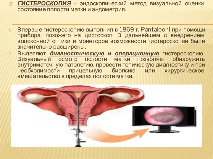 ГИСТЕРОСКОПИЯ - эндоскопический метод визуальной оценки состояние полости матки и эндометрия.