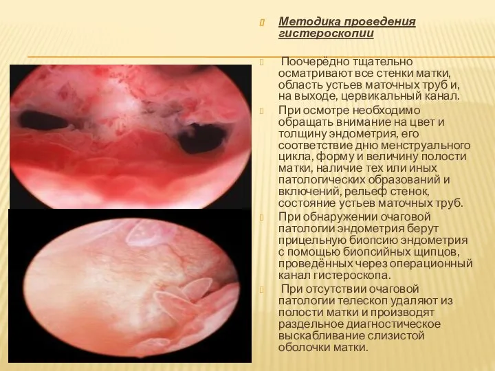 Методика проведения гистероскопии Поочерёдно тщательно осматривают все стенки матки, область устьев