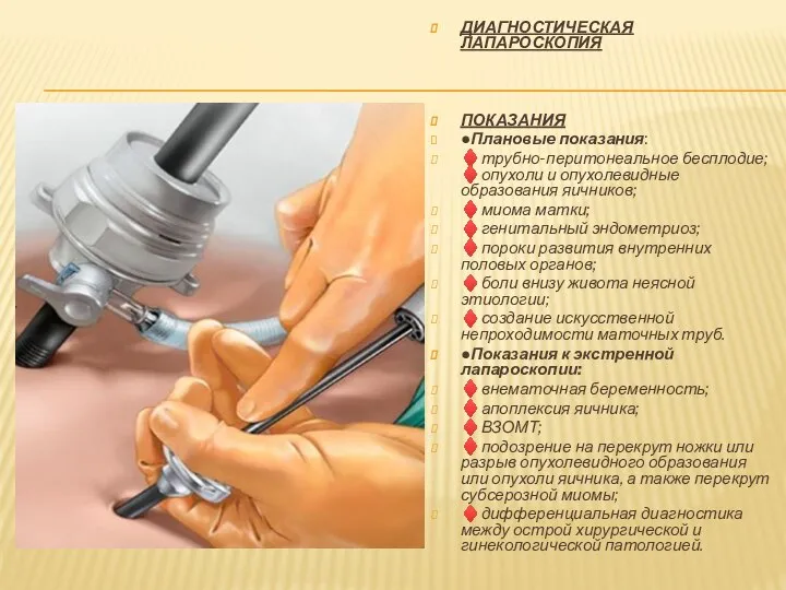 ДИАГНОСТИЧЕСКАЯ ЛАПАРОСКОПИЯ ПОКАЗАНИЯ ●Плановые показания: ♦трубно-перитонеальное бесплодие; ♦опухоли и опухолевидные образования