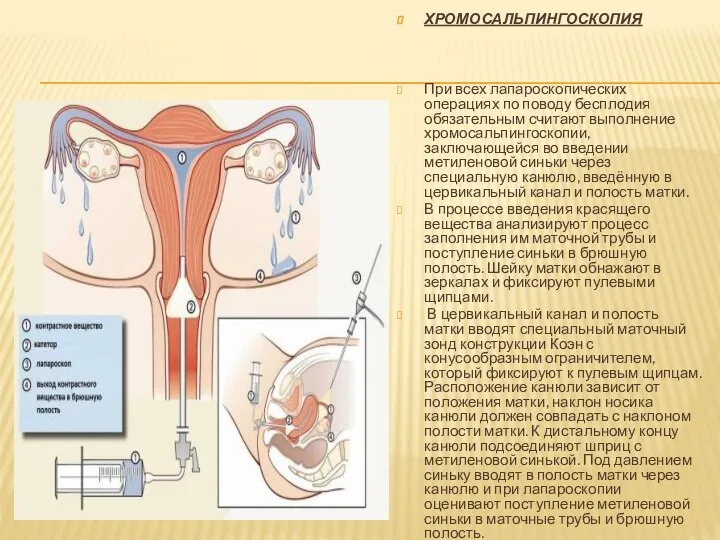 ХРОМОСАЛЬПИНГОСКОПИЯ При всех лапароскопических операциях по поводу бесплодия обязательным считают выполнение