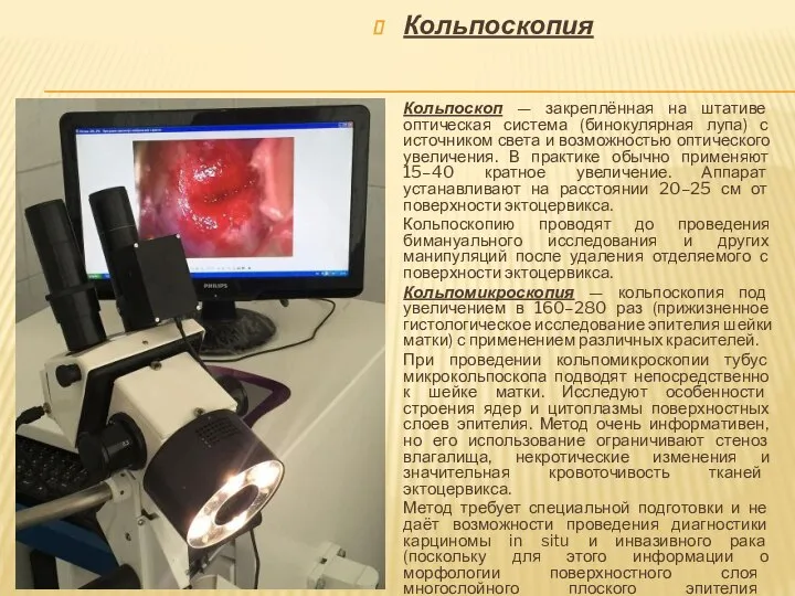 Кольпоскопия Кольпоскоп — закреплённая на штативе оптическая система (бинокулярная лупа) с