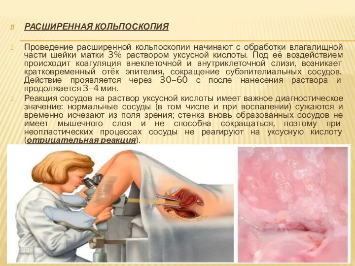 РАСШИРЕННАЯ КОЛЬПОСКОПИЯ Проведение расширенной кольпоскопии начинают с обработки влагалищной части шейки