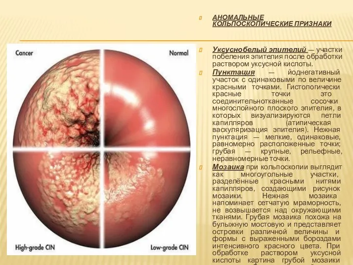 АНОМАЛЬНЫЕ КОЛЬПОСКОПИЧЕСКИЕ ПРИЗНАКИ Уксуснобелый эпителий — участки побеления эпителия после обработки