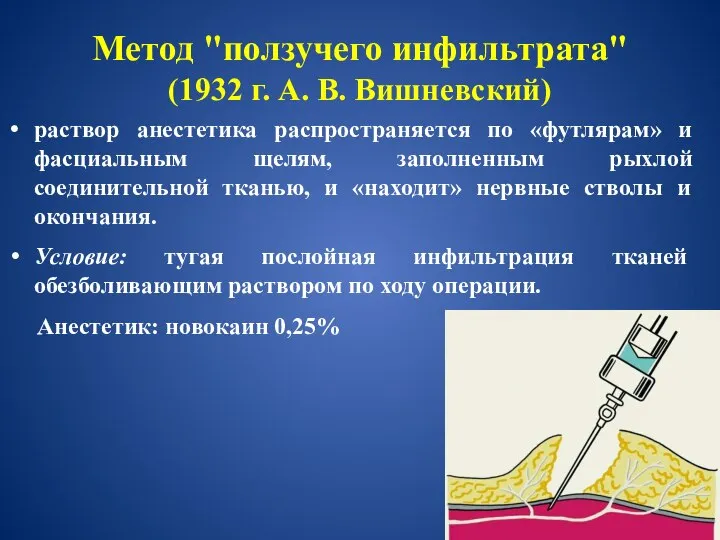 Метод "ползучего инфильтрата" (1932 г. А. В. Вишневский) раствор анестетика распространяется