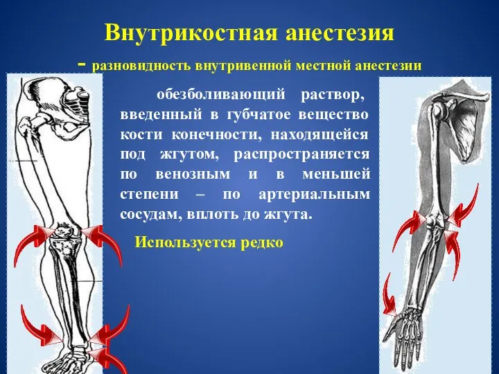 Внутрикостная анестезия - разновидность внутривенной местной анестезии обезболивающий раствор, введенный в