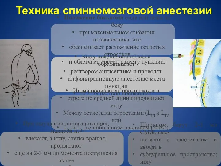 Техника спинномозговой анестезии