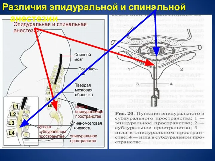 Различия эпидуральной и спинальной анестезии