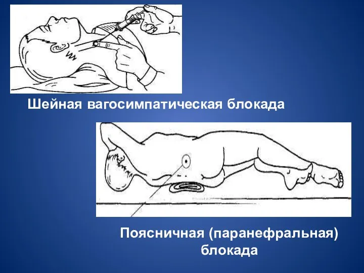 Шейная вагосимпатическая блокада Поясничная (паранефральная) блокада