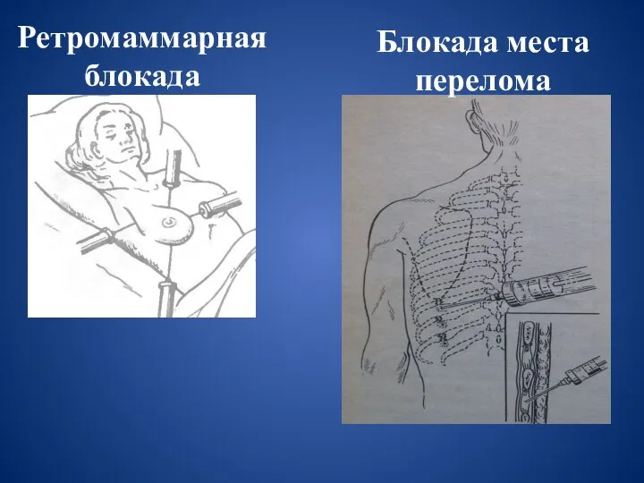 Ретромаммарная блокада Блокада места перелома