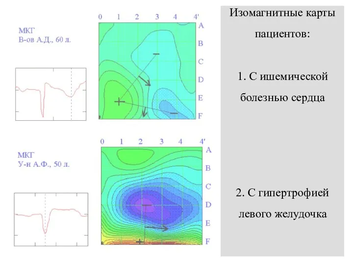 Изомагнитные карты пациентов: 1. С ишемической болезнью сердца 2. С гипертрофией левого желудочка