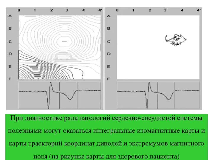 При диагностике ряда патологий сердечно-сосудистой системы полезными могут оказаться интегральные изомагнитные