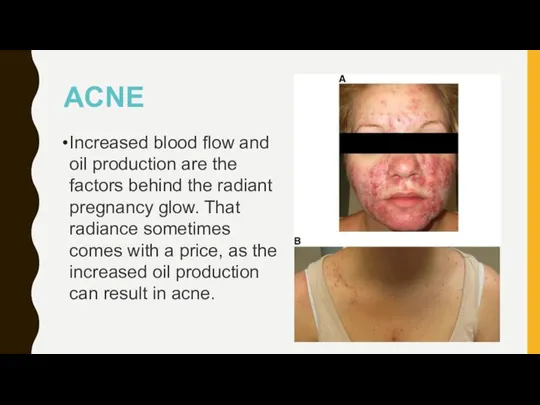 ACNE Increased blood flow and oil production are the factors behind