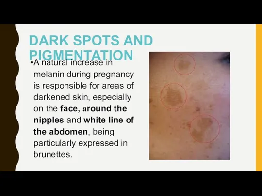 DARK SPOTS AND PIGMENTATION A natural increase in melanin during pregnancy