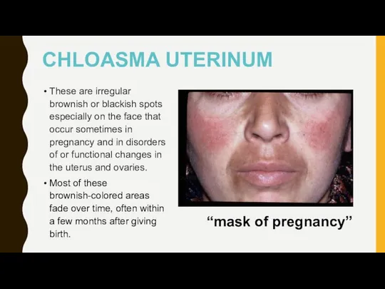 CHLOASMA UTERINUM These are irregular brownish or blackish spots especially on