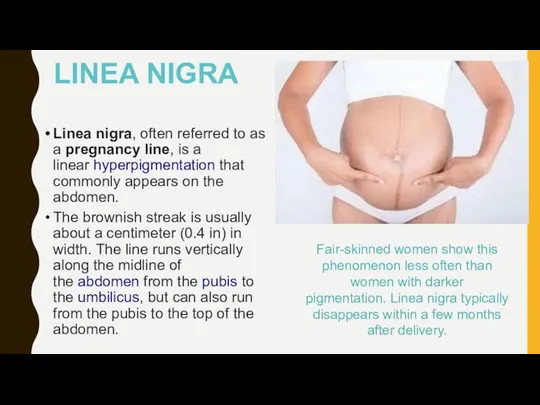 LINEA NIGRA Linea nigra, often referred to as a pregnancy line,