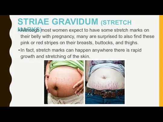 STRIAE GRAVIDUM (STRETCH MARKS) Although most women expect to have some