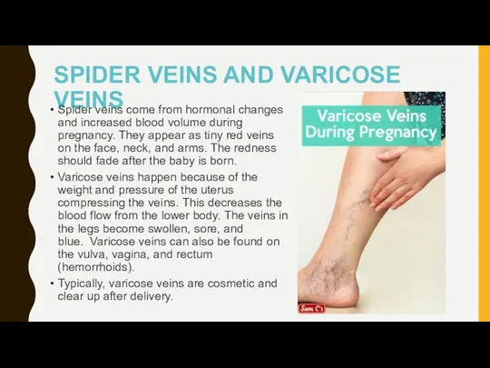 SPIDER VEINS AND VARICOSE VEINS Spider veins come from hormonal changes