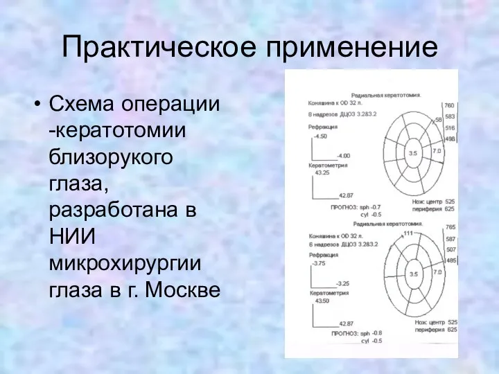 Практическое применение Схема операции -кератотомии близорукого глаза, разработана в НИИ микрохирургии глаза в г. Москве